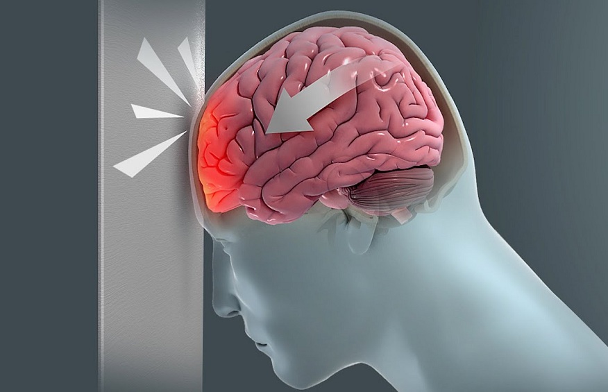 How Pupillary Response Indicates Traumatic Brain Injury: Utilizing Neuro Exam and NPi