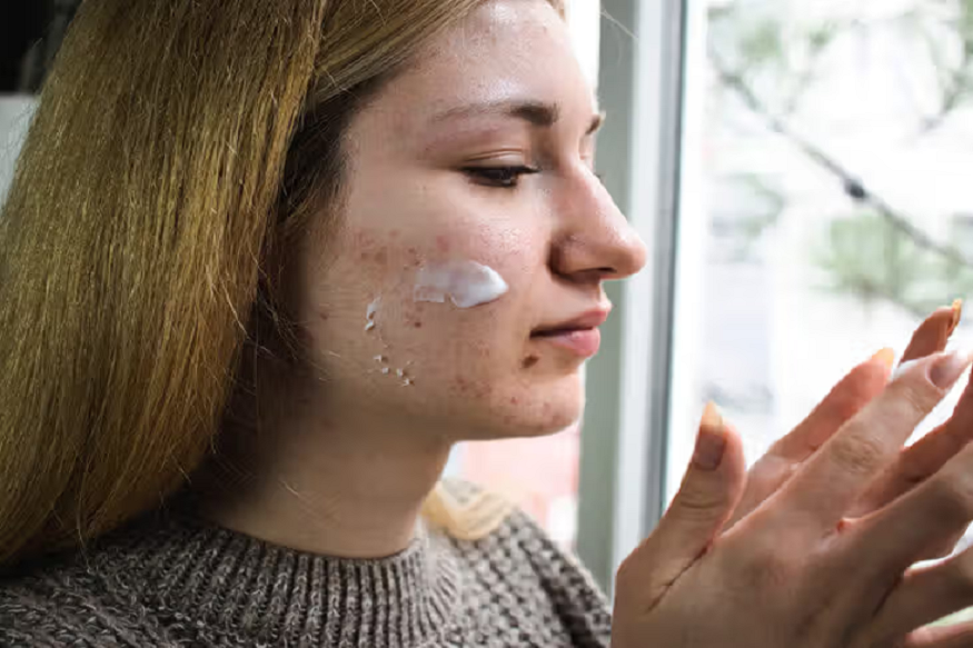 trusted facial acne treatments